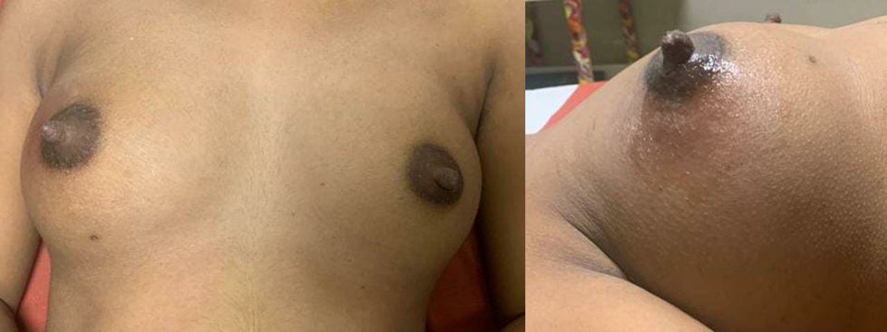 26-year-old lactating mother, with painless lump in the retro-areolar region of right breast with milky nipple discharge seen