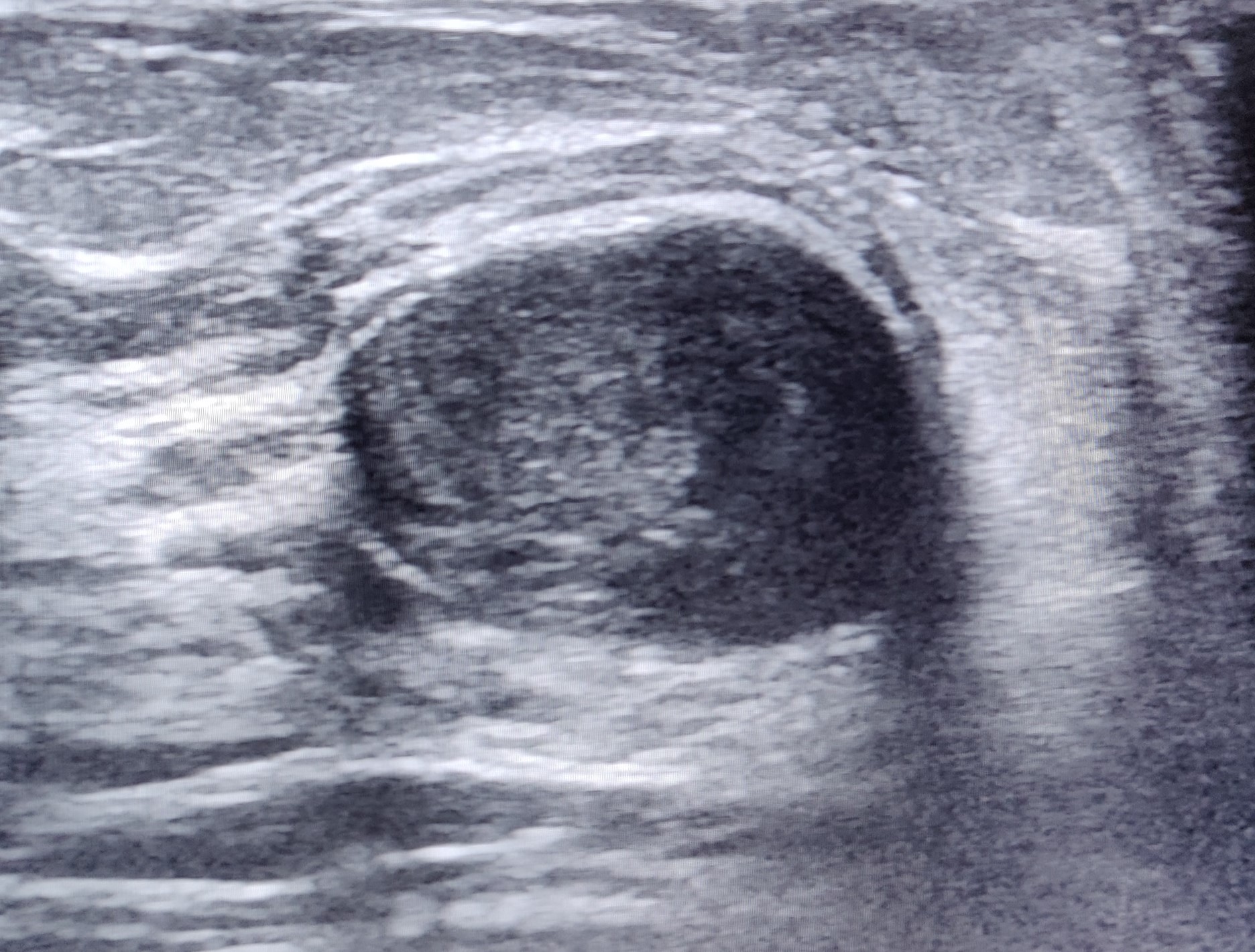 Ultrasound image showing round echoic cyst suggestive of inspissated galactocele