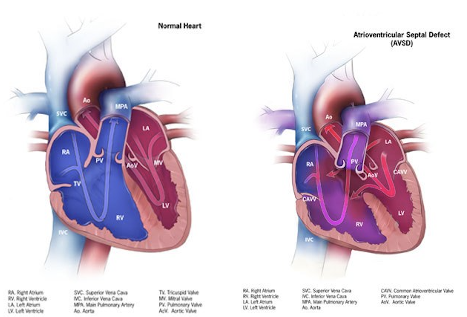 Diagram comparing a normal heart to a heart with atrioventricular septal defects.