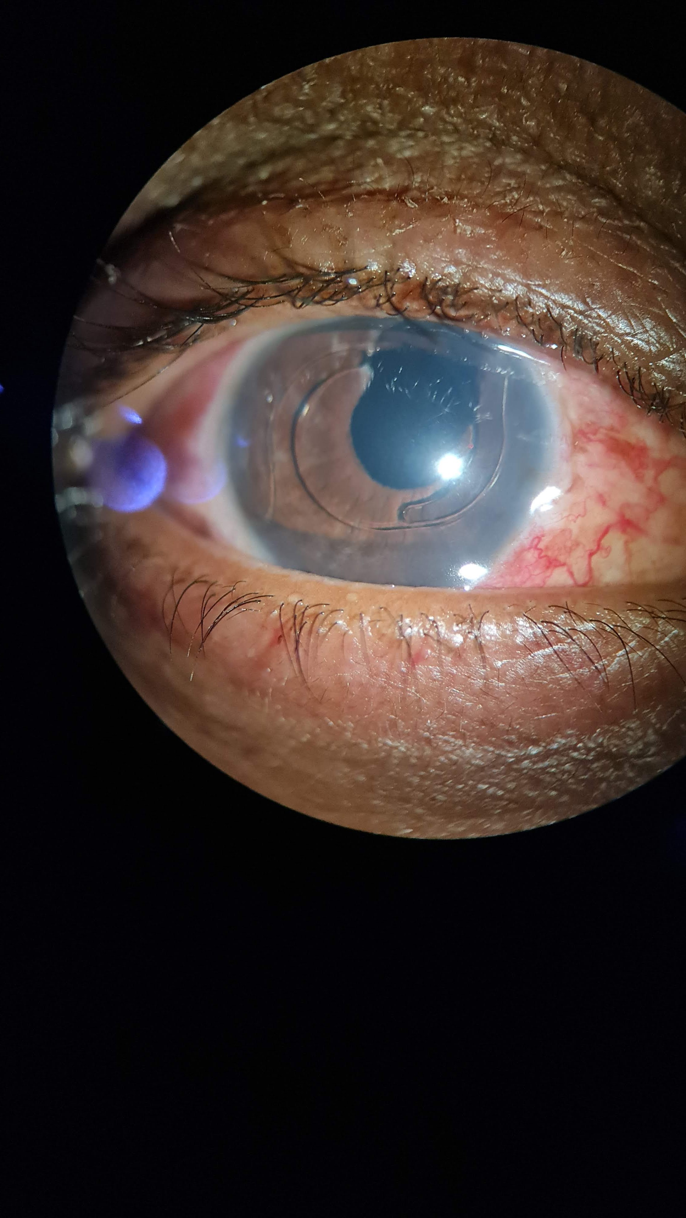 <p>Uveitis Hyphema Glaucoma Syndrome Indicating Iridectomy