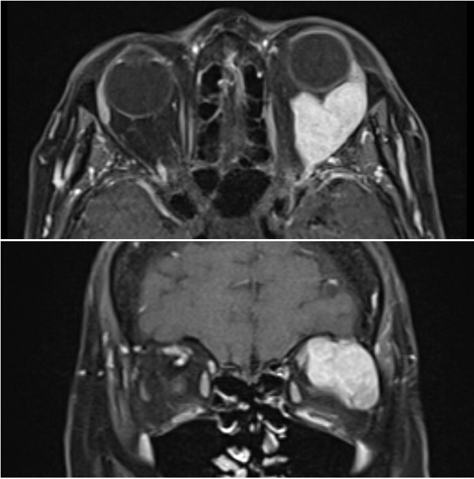 45 year old patient with left eye proptosis and vision changes, found to have a left orbital mass. Post-contrast T1 MRI images shows an avidly enhancing solid mass arising from the lacrimal gland fossa extending posteriorly towards the orbital apex, with surrounding erosion of the bone. Biopsy of the mass resulted in a diagnosis of adenoid cystic carcinoma.