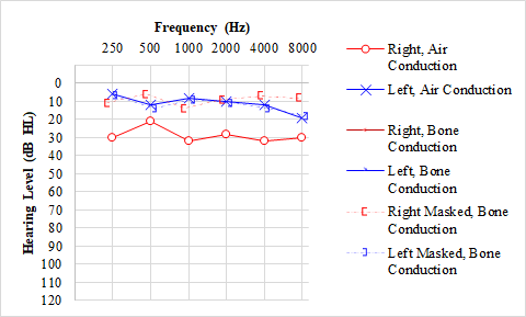 Audiogram showing a right conductive hearing loss in a patient with otitis media with effusion.