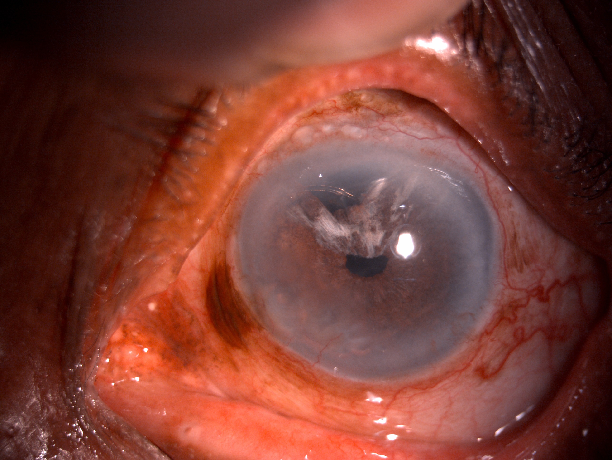 Slit lamp image of the patient depicting conjunctival congestion, superior two clock hour iridodialysis, iris chaffing and haptic of IOL extruding through the iridodialysis area