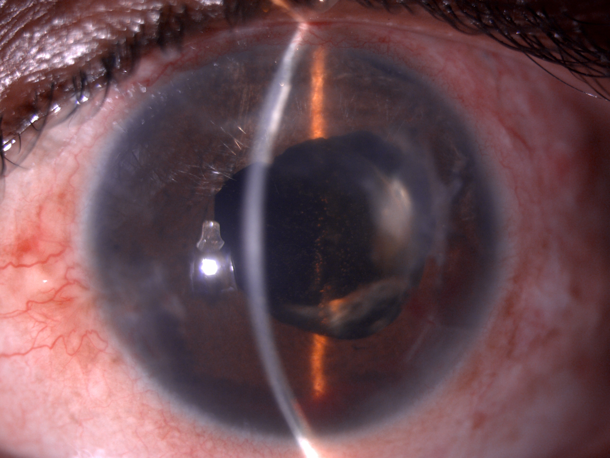 Slit lamp image of the patient post nasal iridodialysis repair by McCannel technique
