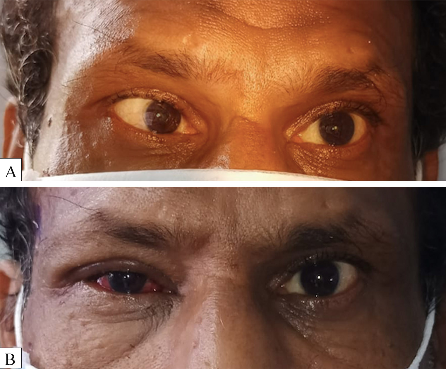 A. Digital preoperative image of a 50-year-old male patient depicting Hirschberg corneal reflex of 20 degree esotropia in the right eye B. Post operative day 1 image of the same patient depicting orthotropic Hirschberg corneal reflex after undergoing 5 mm medial rectus recession and 7 mm lateral rectus resection in the right eye 