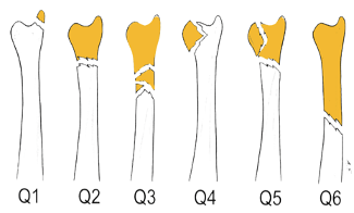 AO Classification for Distal Ulna Fractures