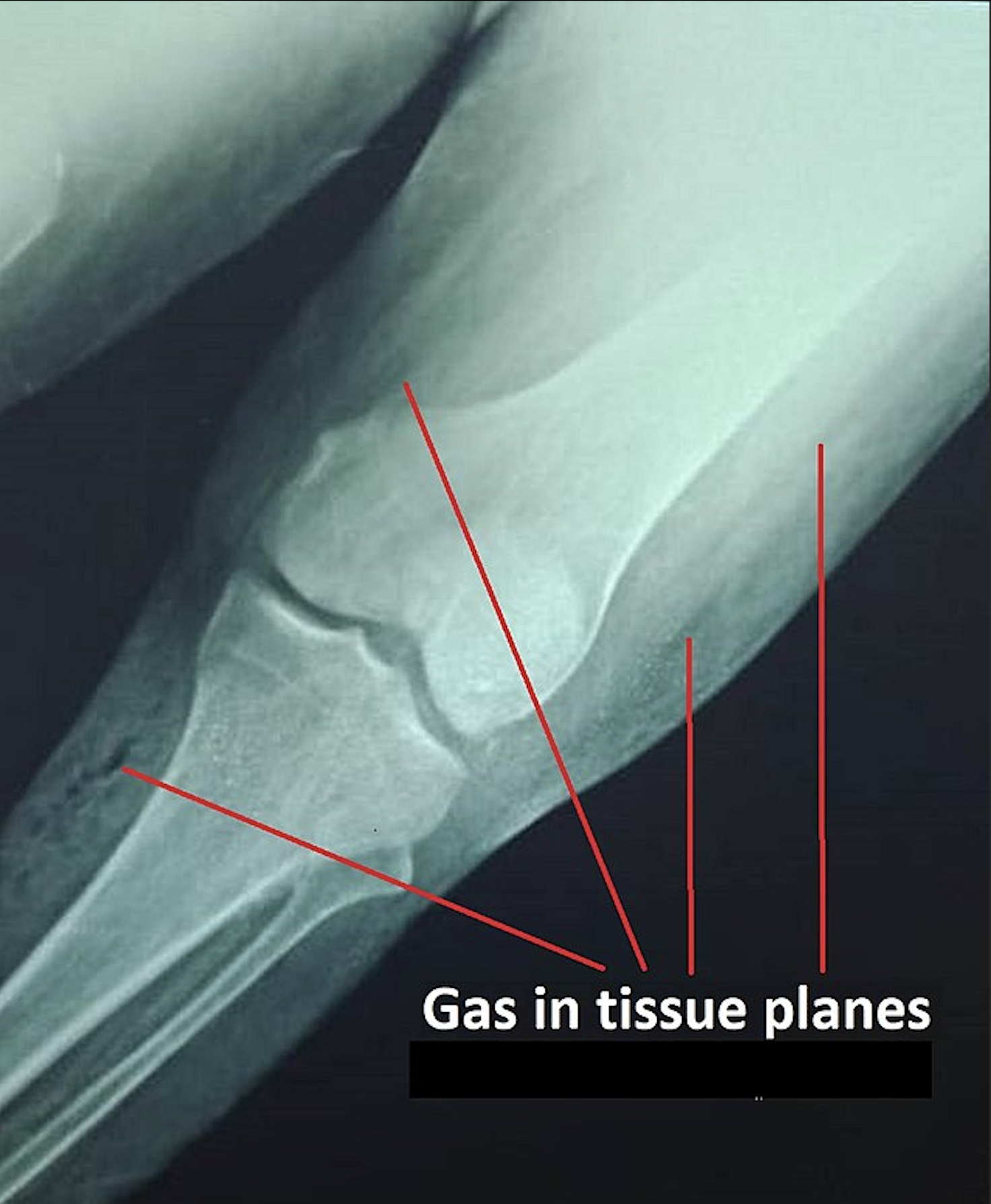 Plain x-ray showing gas in the tissue planes in a patient with gas gangrene.