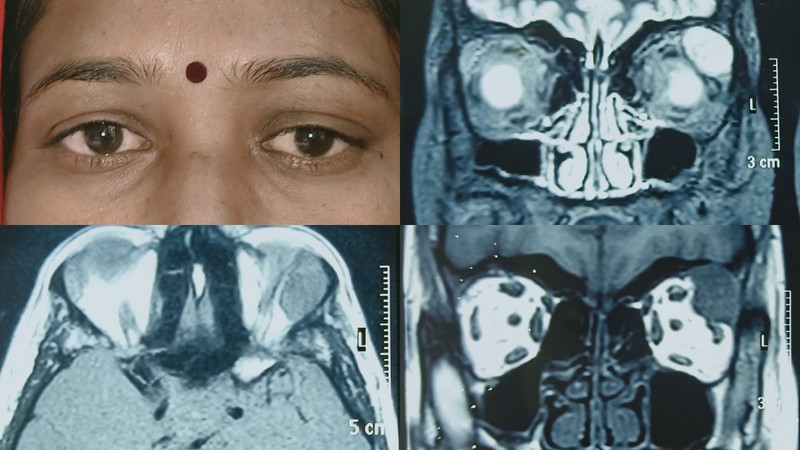 The clinical photo showed abaxial proptosis in the left side with inferomedial globe dystopia in the left eye