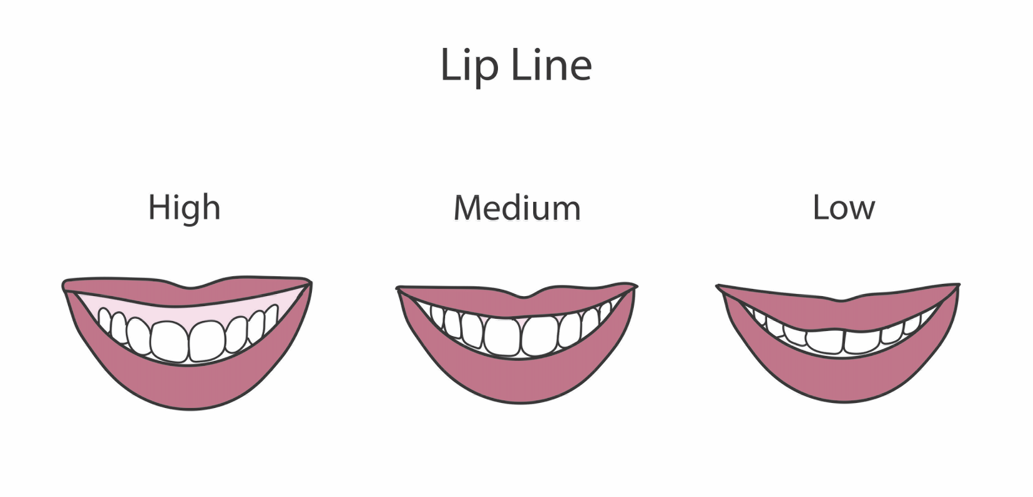 Examples of low, medium, and high lip lines.