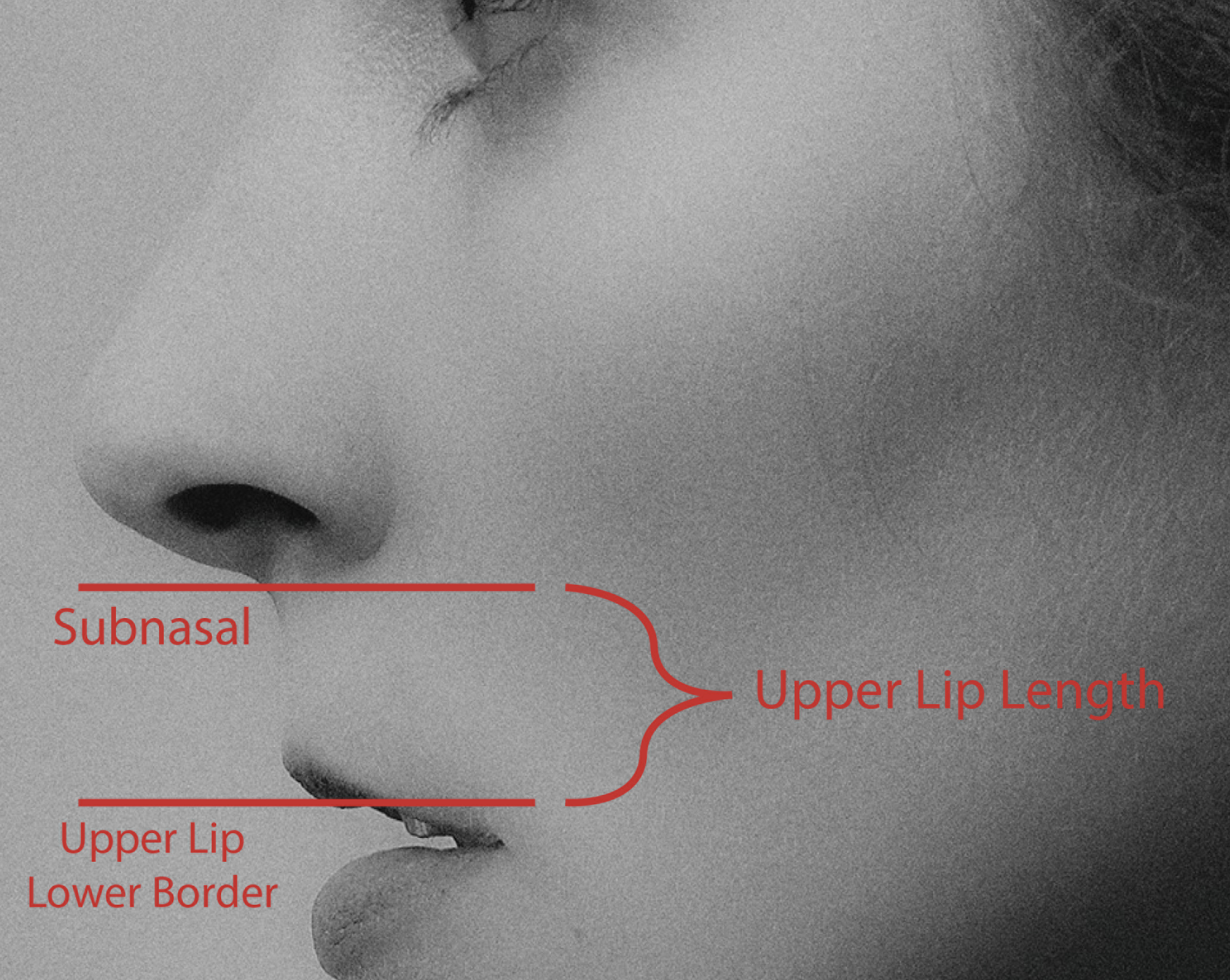 Example of upper lip length measurement.