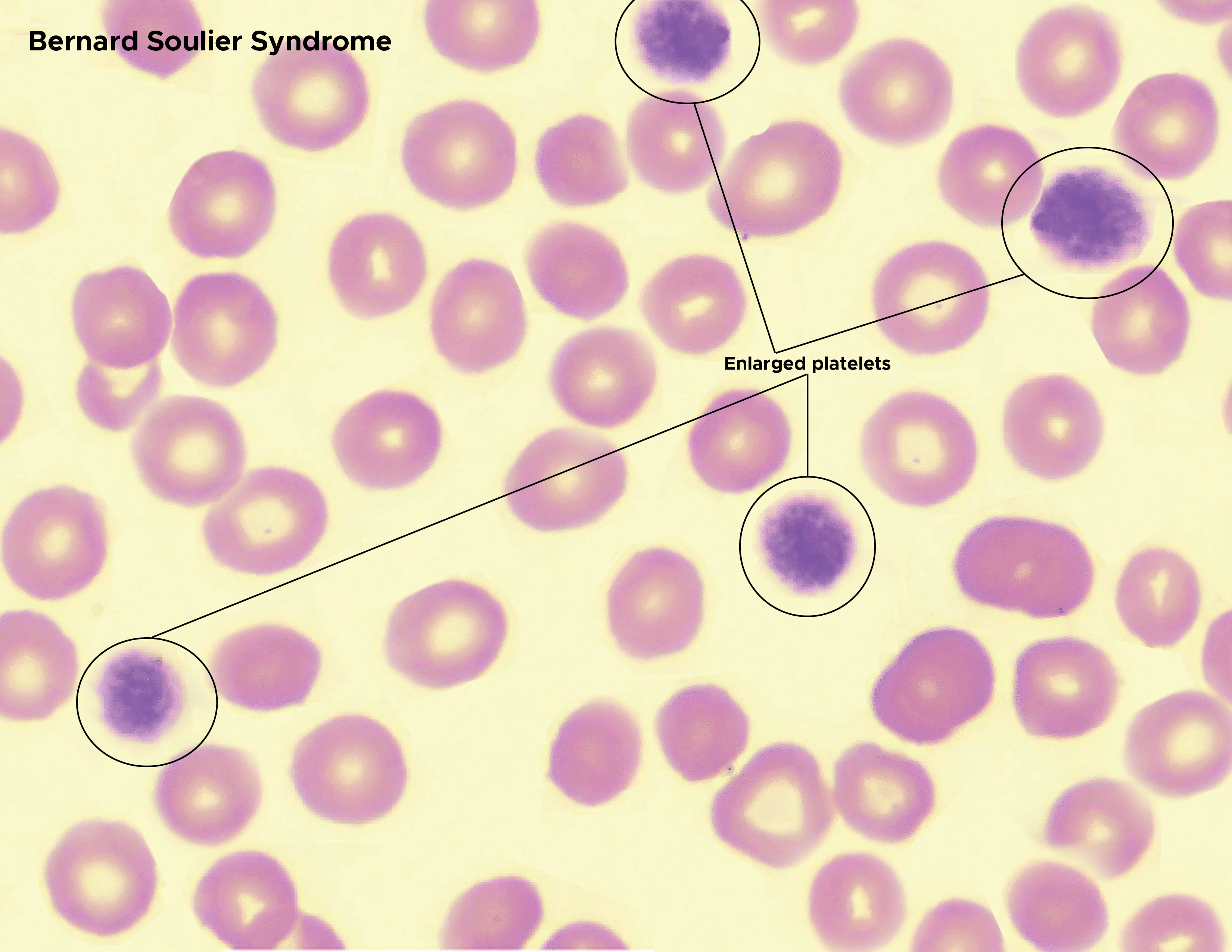 Bernard Soulier Syndrome. Enlarged platelets, red blood cells