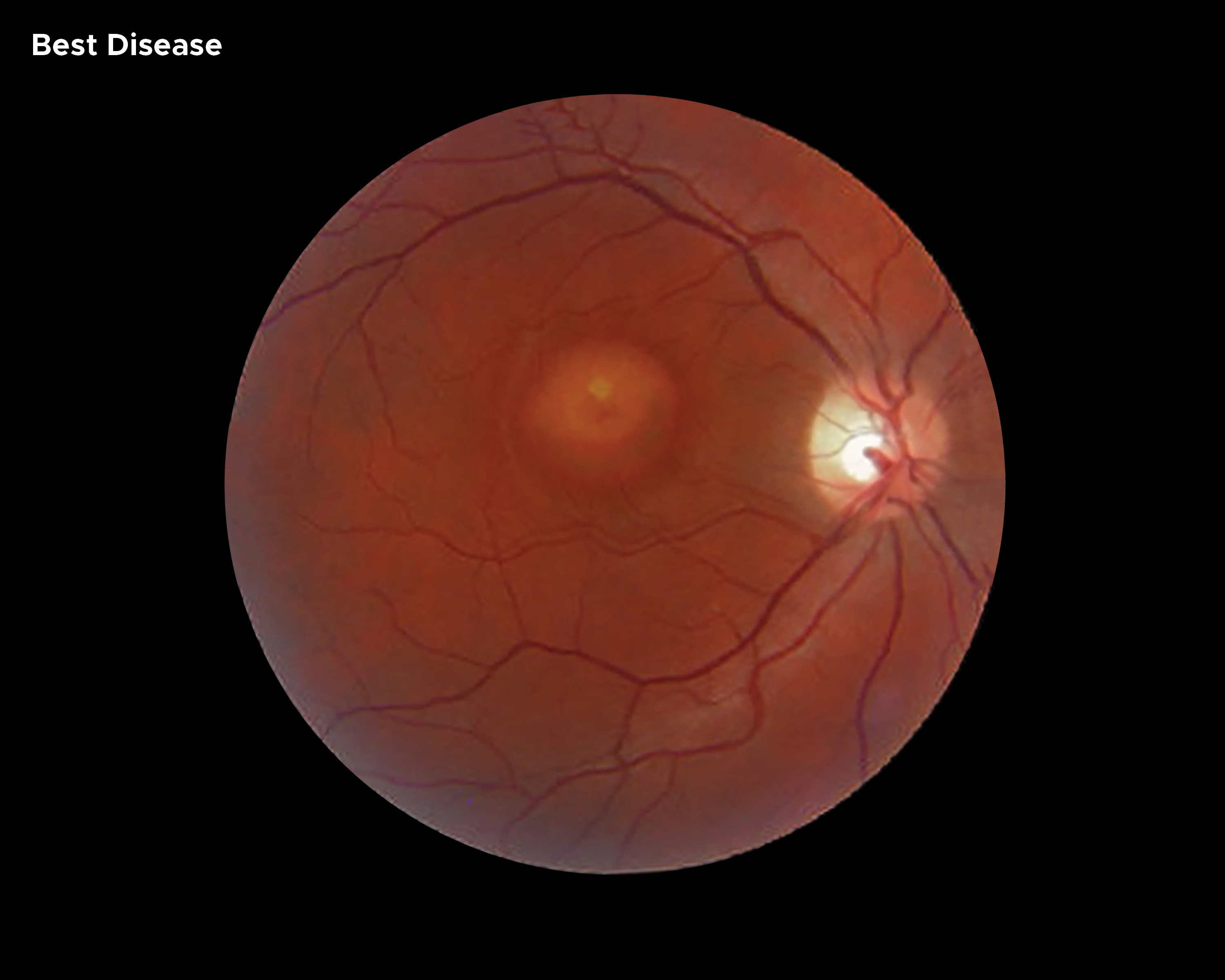 Image of eye with Best Disease