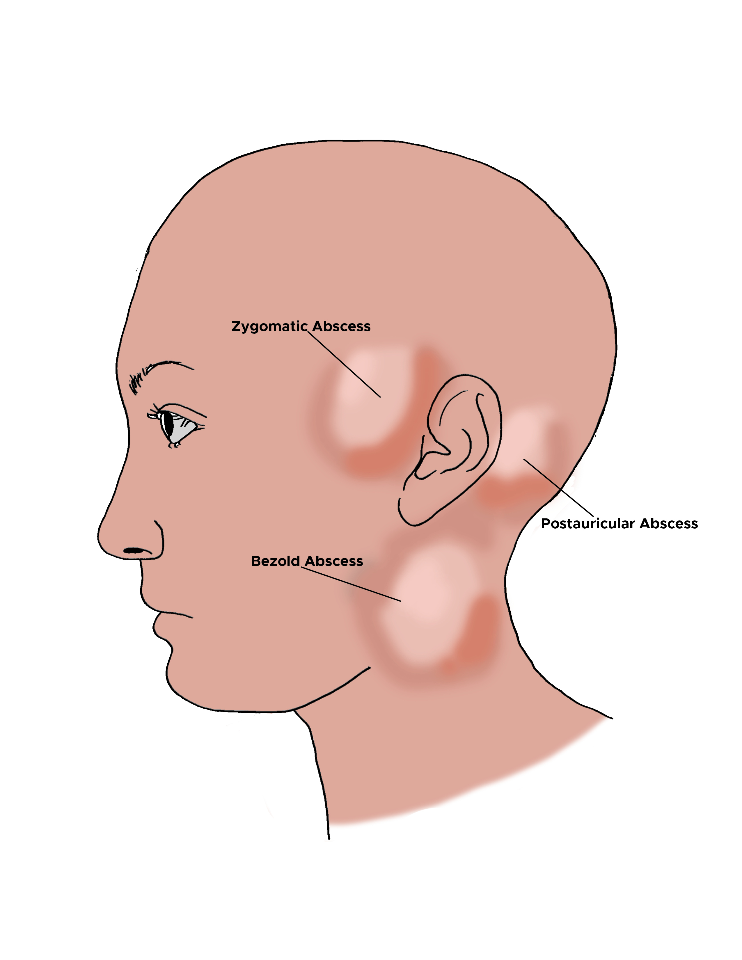 Illustration of abscesses on side of head. Zygomatic abscess, postauricular abscess, bezold abscess.