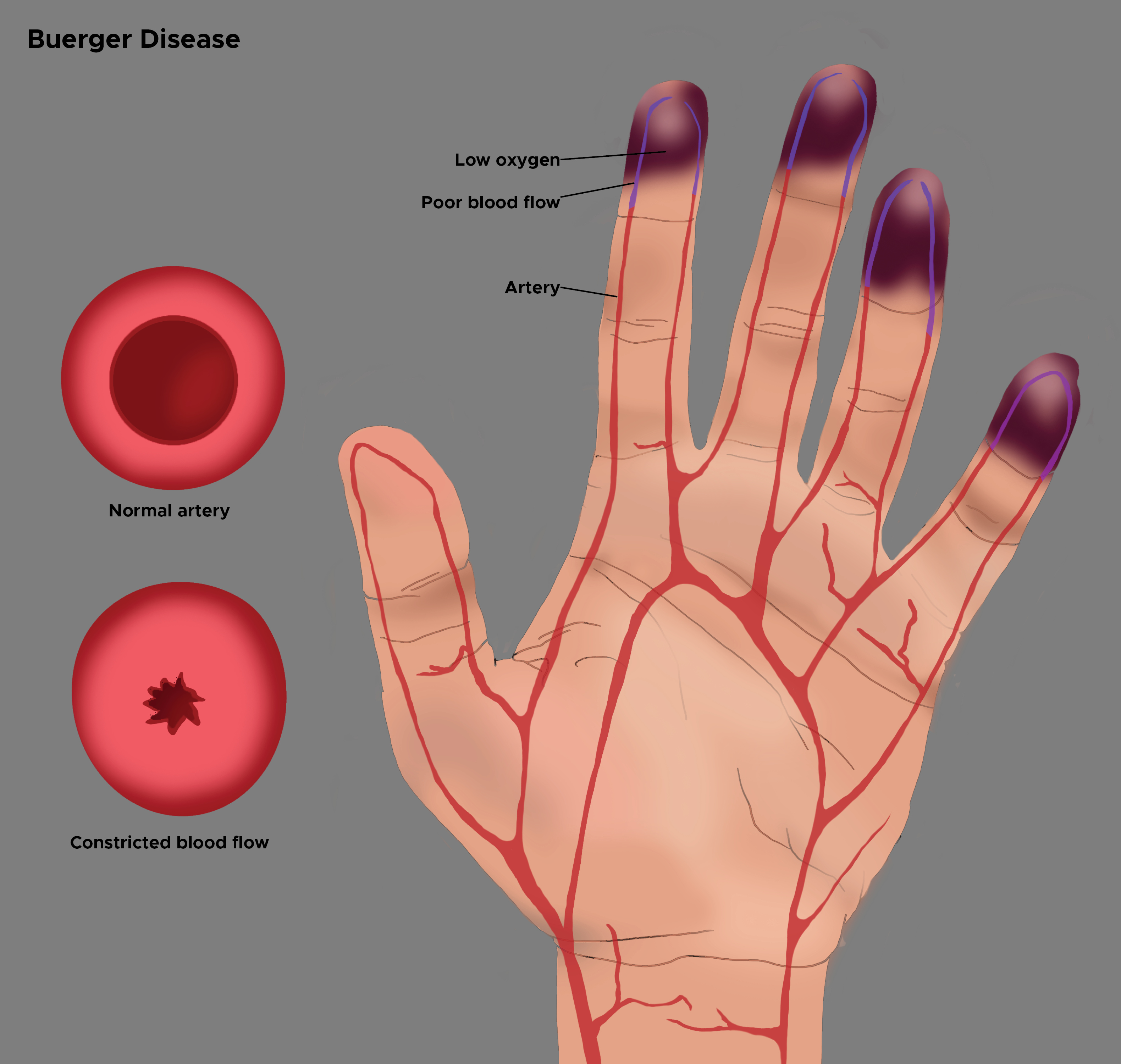 Illustration of Buerger disease. Low oxygen and constricted blood flow to the fingertips. Arteries of hand. 