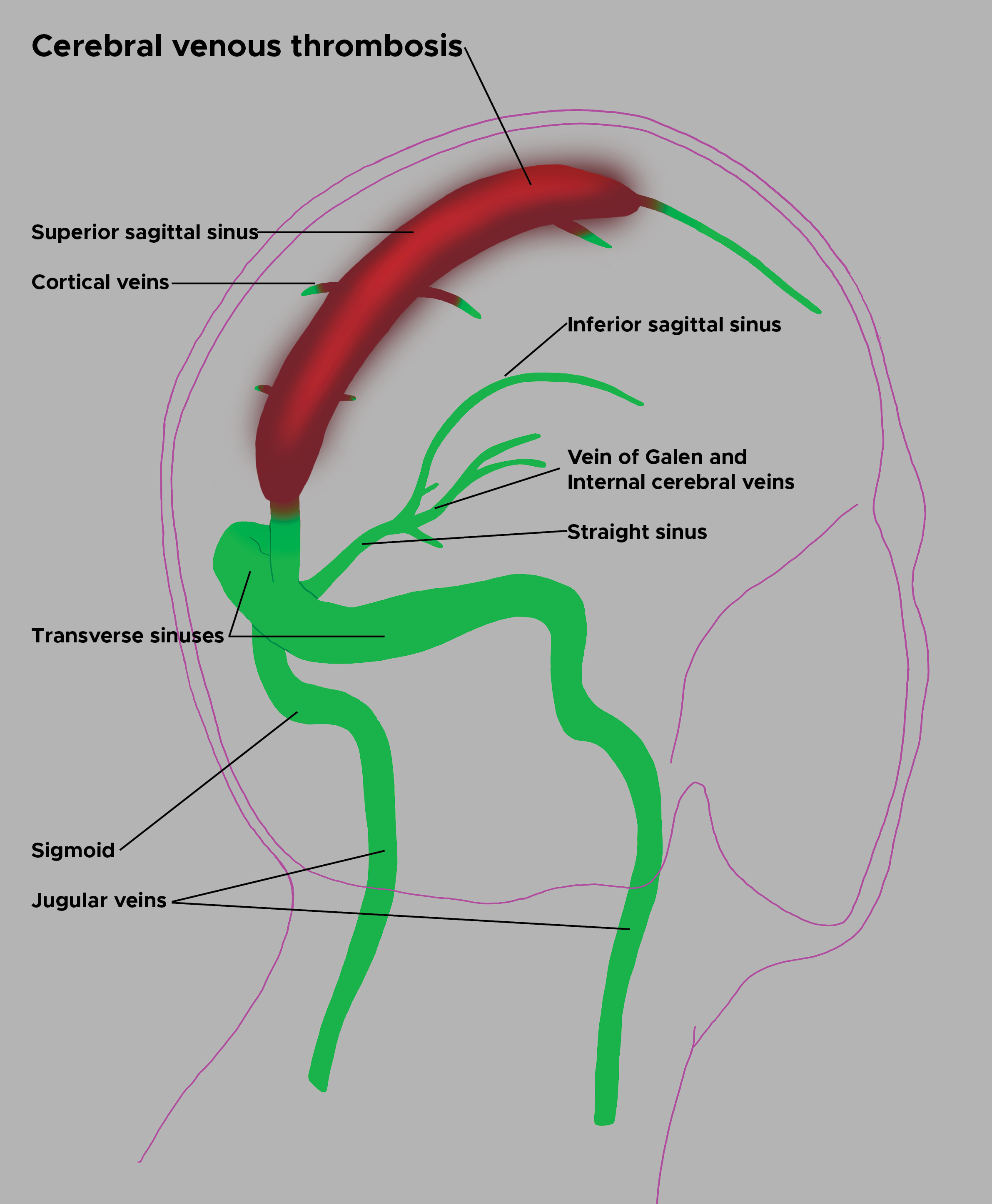 Illustration of cerebral venous thrombosis
