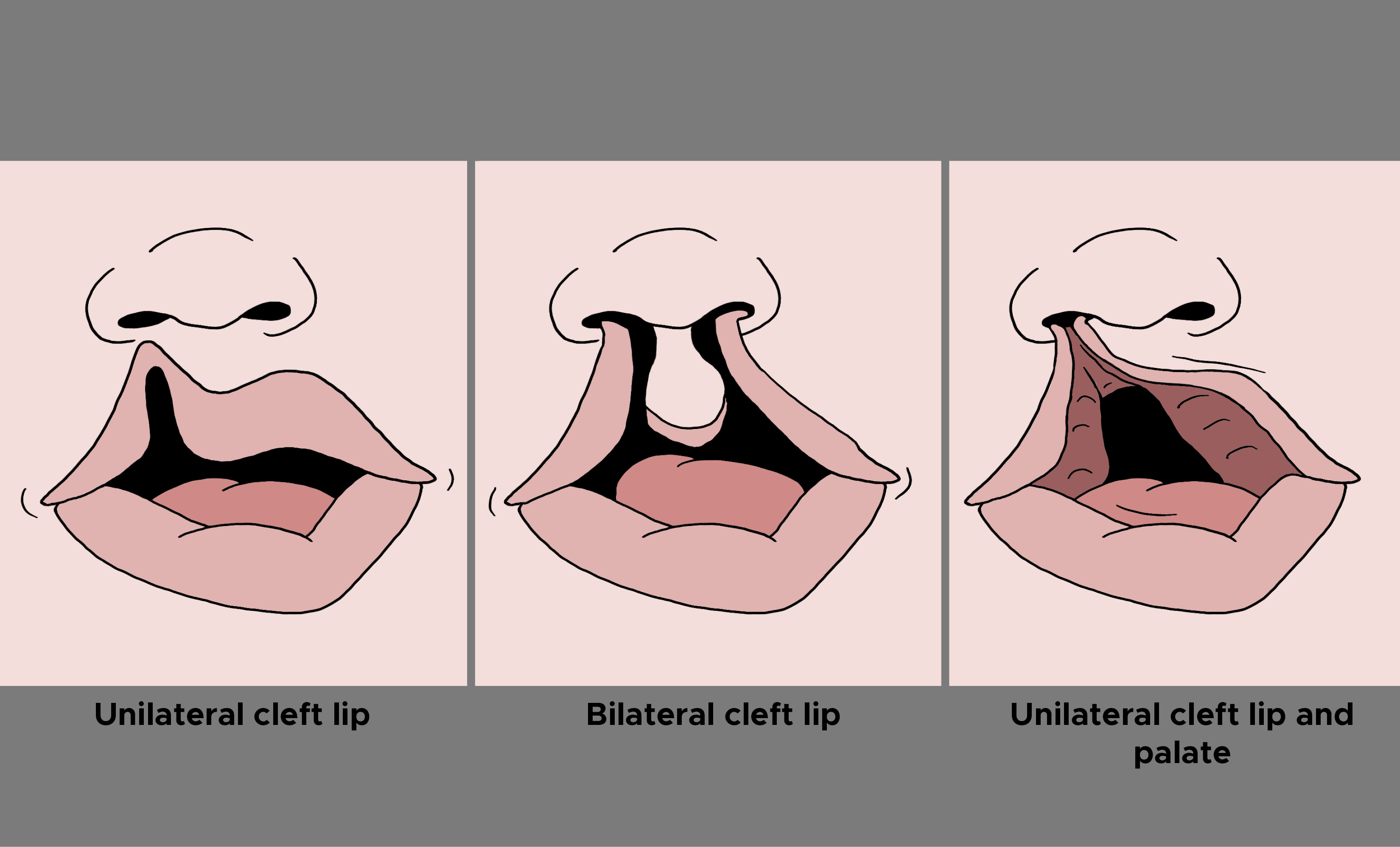 Illustration. Unilateral cleft lip, bilateral cleft lip, unilateral cleft lip and palate