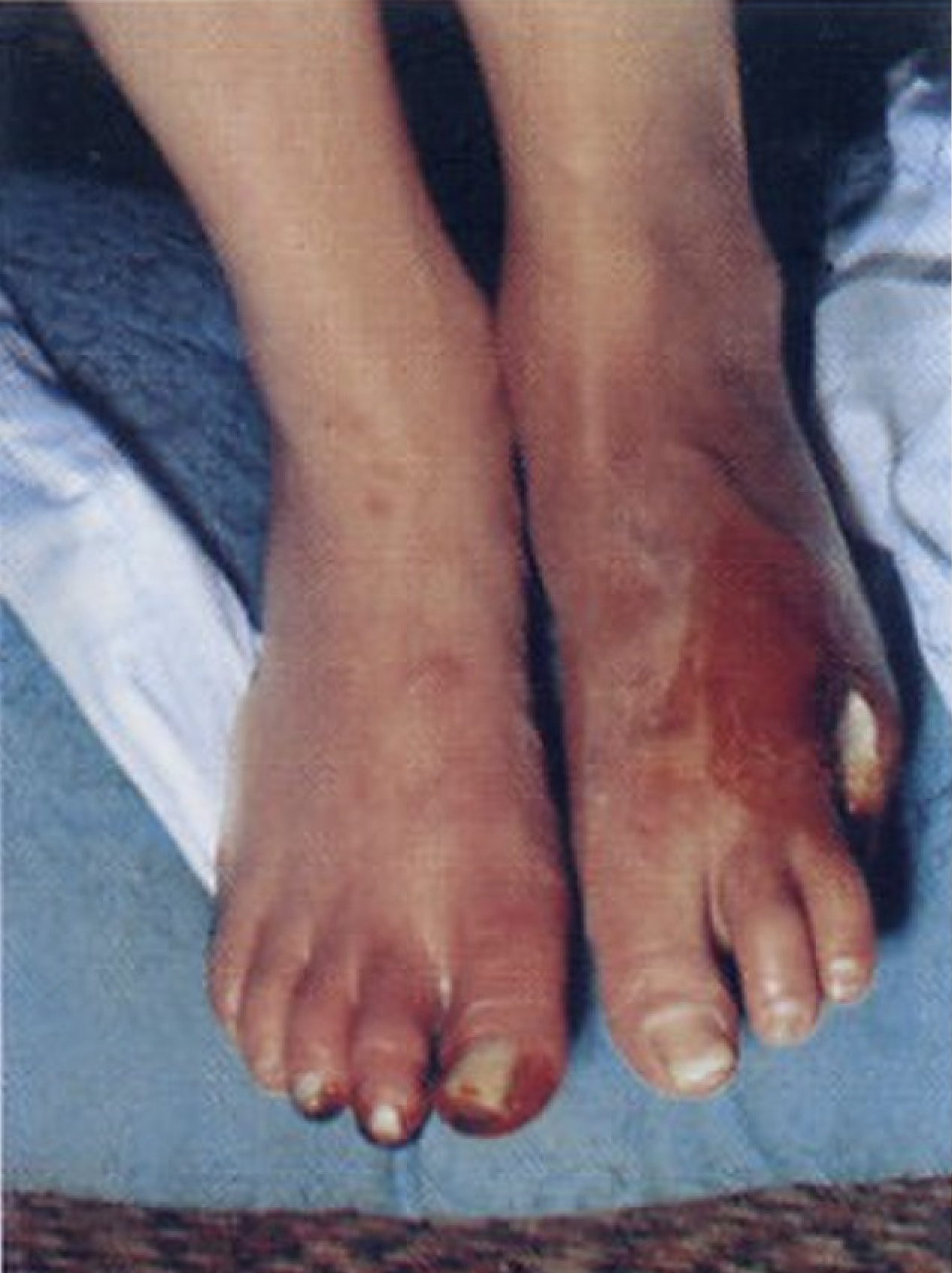 Middle aged female with advanced Buerger disease.