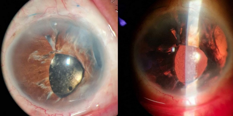 UGH (Uveitis Glaucoma Hyphema) syndrome after scleral fixated intraocular lens (SFIOL) and iris repair