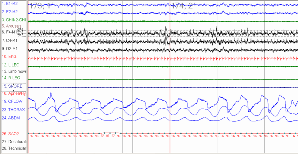 A polygraph from in-laboratory polysomnography (PSG) showing during N2 sleep period of inspiratory flow limitation (flattening of inspiratory phase on flow signal) without associated desaturation or definitive hypopnea. 
