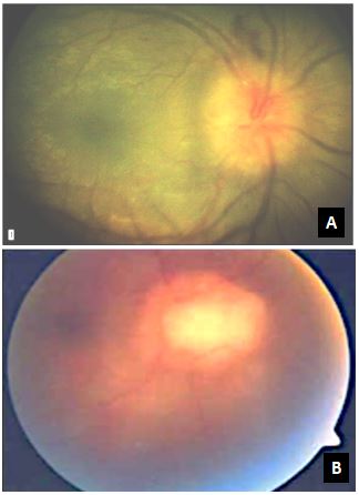 Figure 3: Fundus photograph showing optic nerve head swelling and granuloma