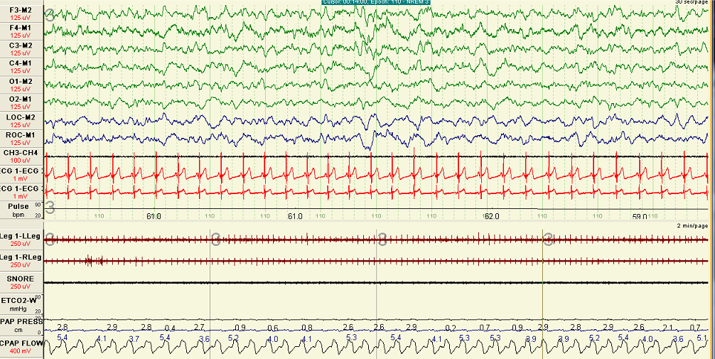 A polygraph during NREM sleep after optimal CPAP titration is achieved. Note the flow contour during inspiration is rounded and flow limitation is not present. 