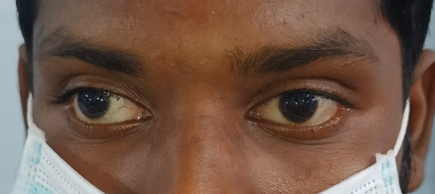 Digital image of the patient depicting an exotropia of approximately 40 degrees in the right eye while fixing with the left e