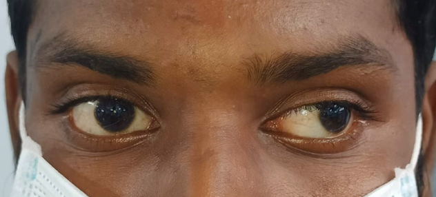 Digital image of the patient depicting an exotropia of approximately 40 degrees while the patient is fixing with his right ey