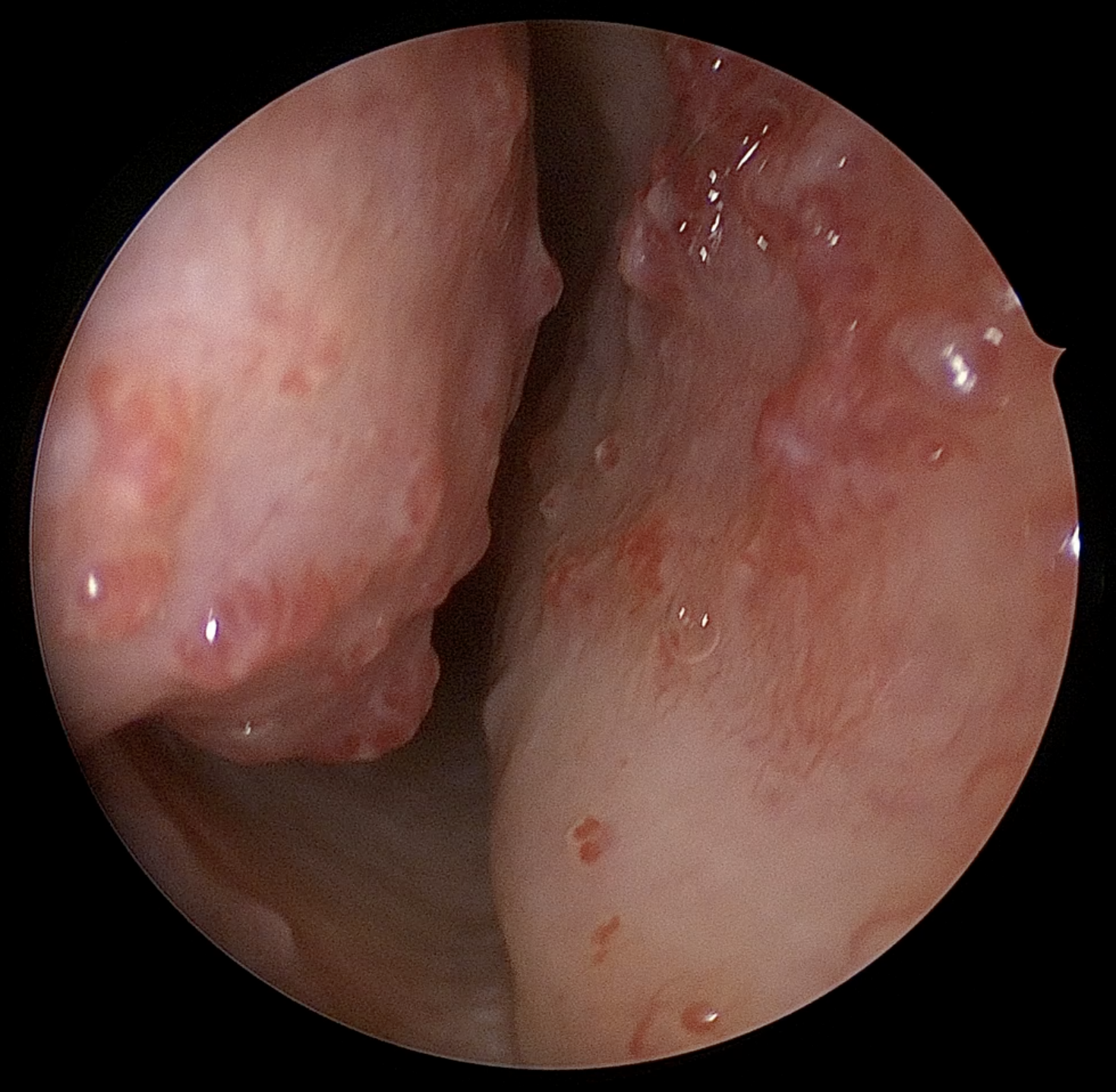 Rigid nasal endoscopy of the right nasal cavity demonstrating telangiectasias in HHT