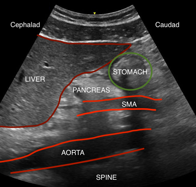 Gastric ultrasound anatomy, including liver, pancreas, stomach, superior mesenteric artery, aorta, and spine. 
