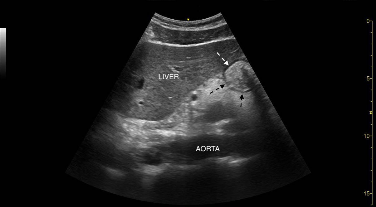 Gastric ultrasound image highlighting hypoechoic muscular layer of stomach. 