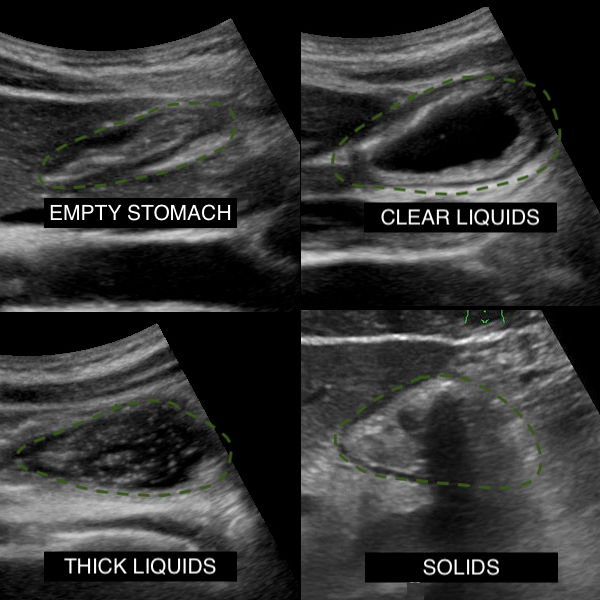 Sonographic appearance of empty stomach, clear liquids, thick liquids, and solids.