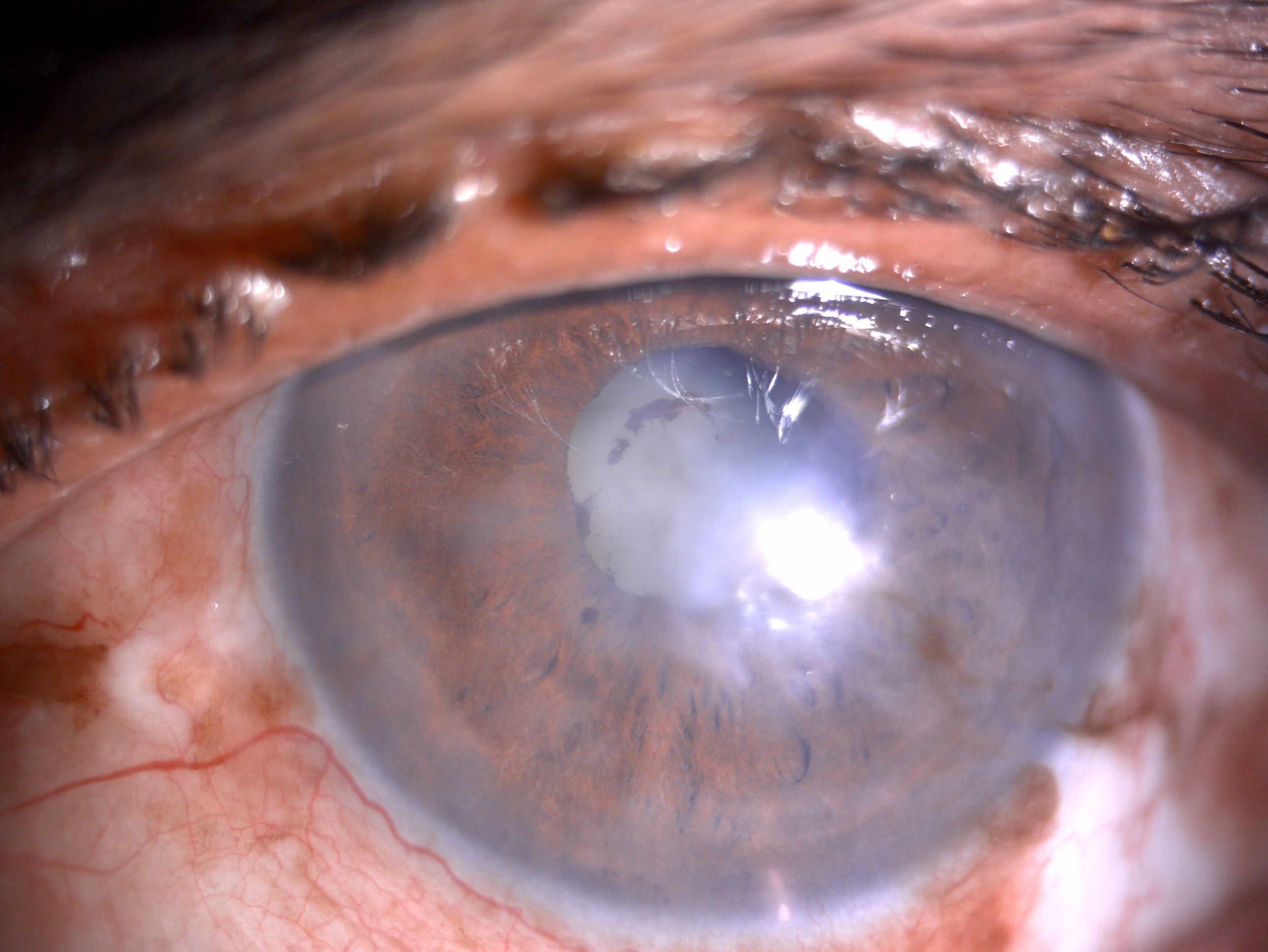 Slit- lamp image of the patient with recurrent uveitis depicting mild circumciliary congestion, nebular corneal scarring, few areas of iris atrophy along with a complicated cataract