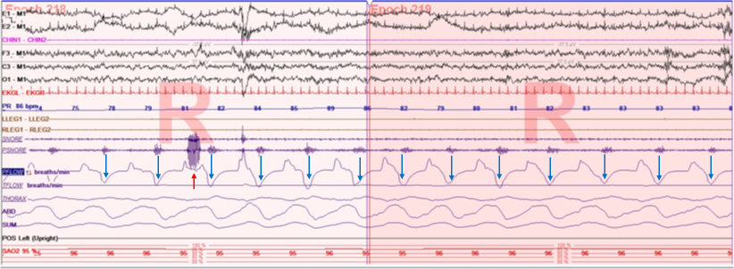 A polygraph depicting snoring and flow limitation during REM sleep in inspiratory (red arrow) and expiratory (blue arrows) phases, respectively. Note that inspiratory phase is upward and expiratory phase is downward. 