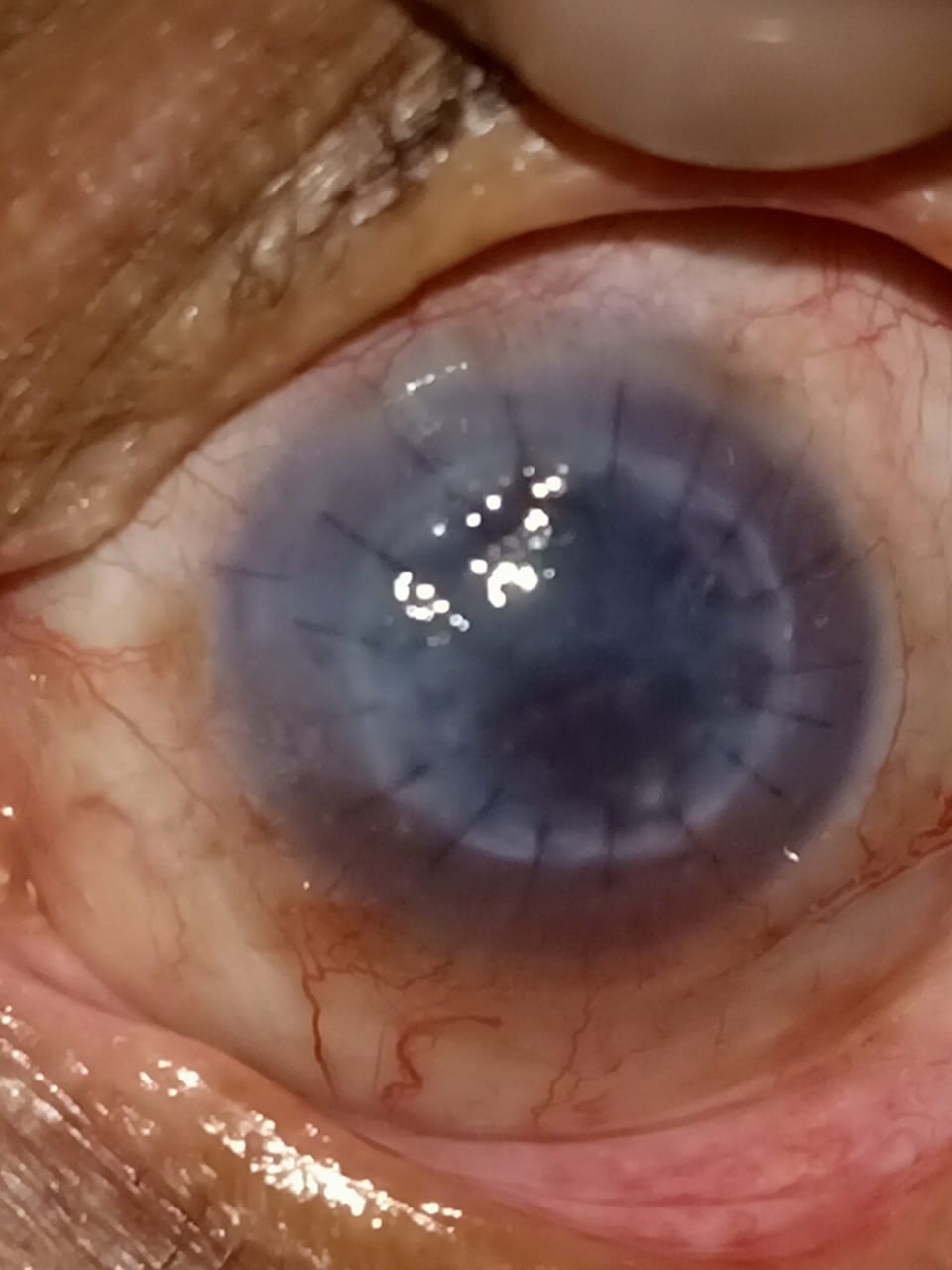 Digital slit lamp image of the left eye of the patient depicting mild congestion, epithelial edema, stromal edema, well oppos