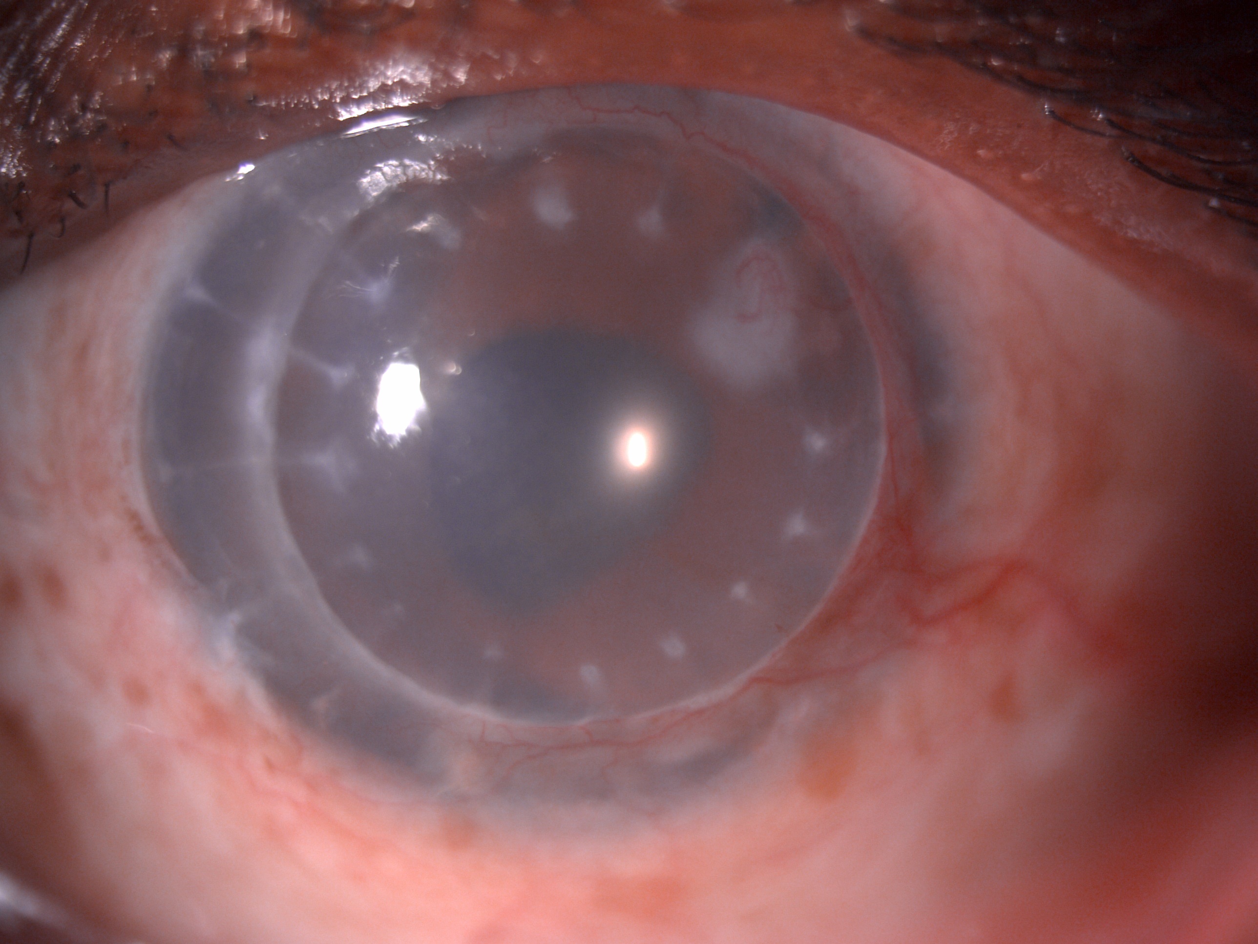 Digital slit lamp image of the patient's left eye depicting mild circumciliary congestion, well opposed graft host junction, stromal edema, suture marks, stromal scar with ghost vessels at 2 o'clock adjacent to the graft host junction