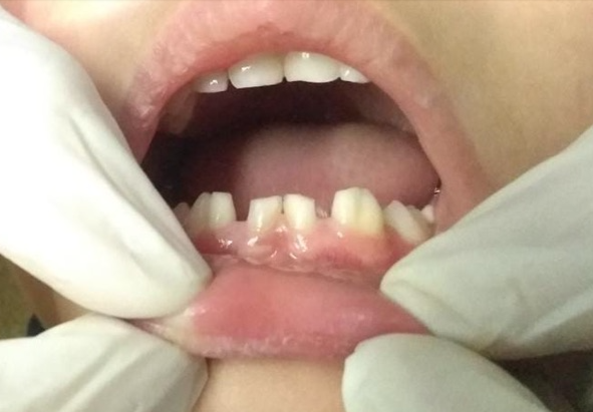 Dental fusion in primary dentition.
