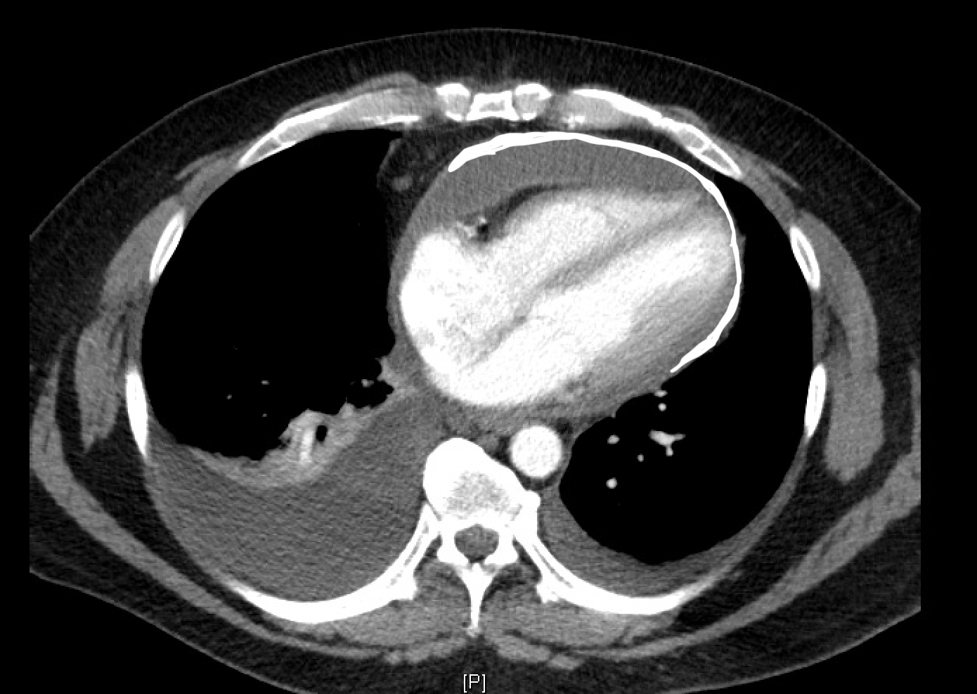 Pericardial calcification and pericardial thickening (maximum anterior thickness 2.2 cm) in a patient with constrictive pericarditis.
