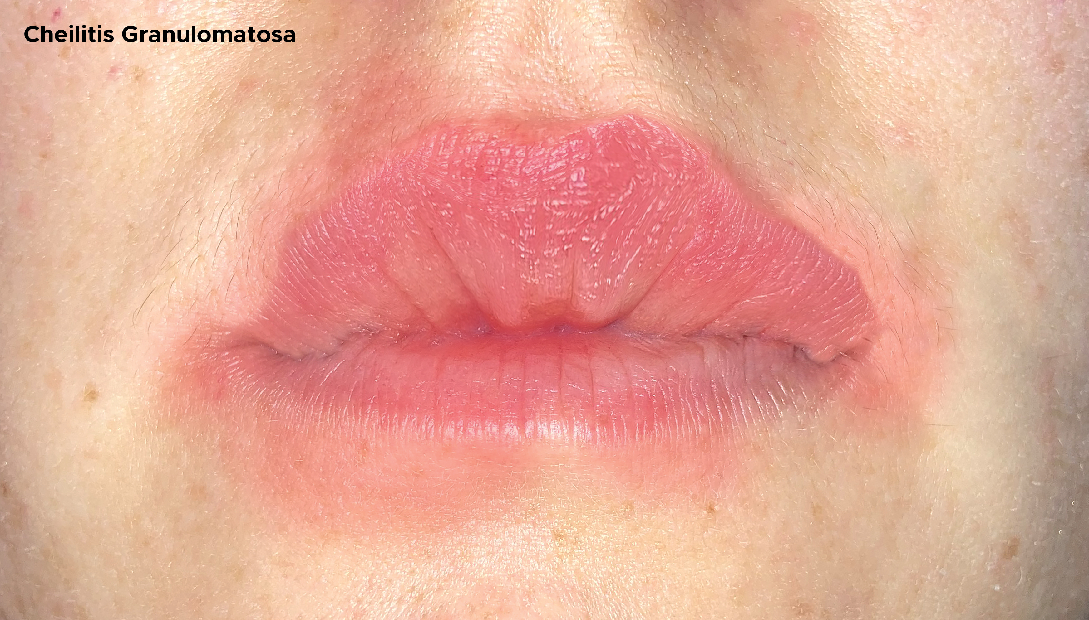 Illustration of upper lip. Cheilitis granulomatosa