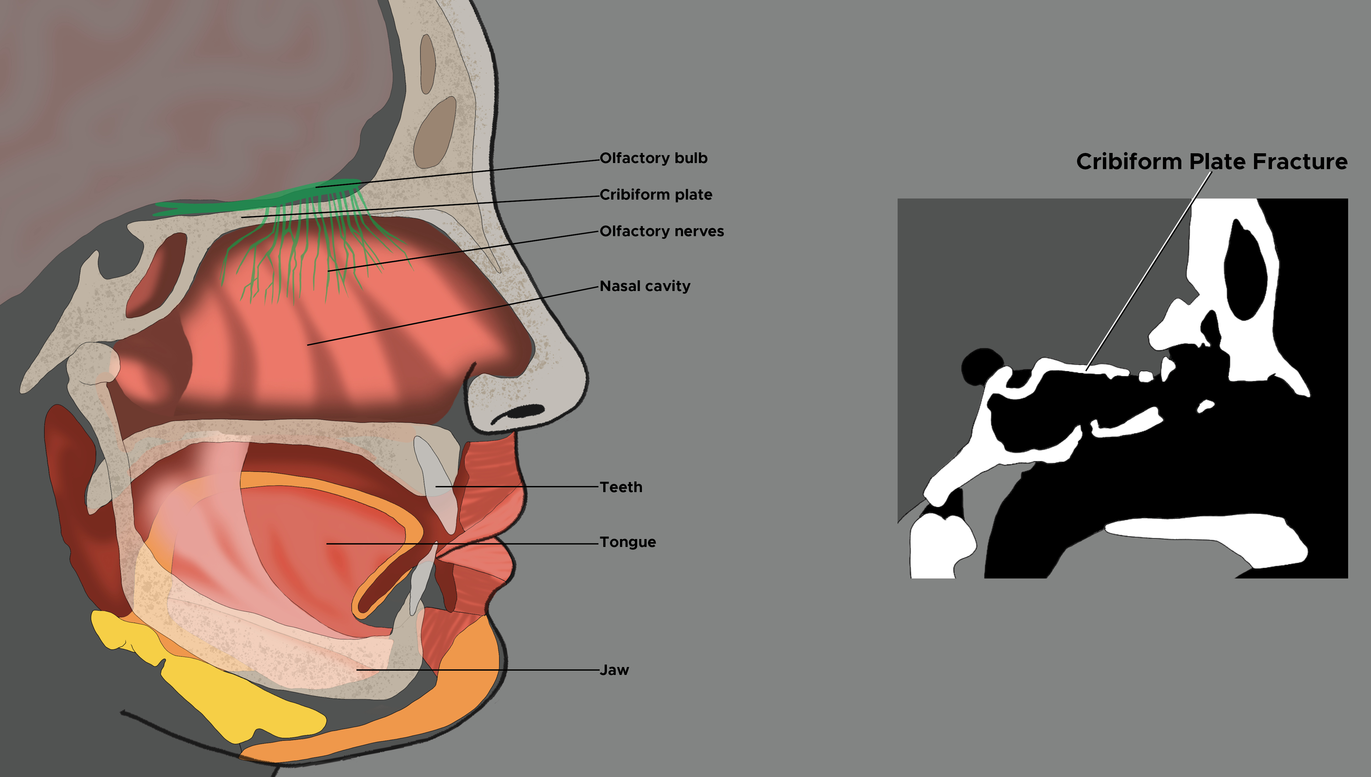 Illustration of head and sinus, olfactory bulb and nerves, cribiform plate fracture