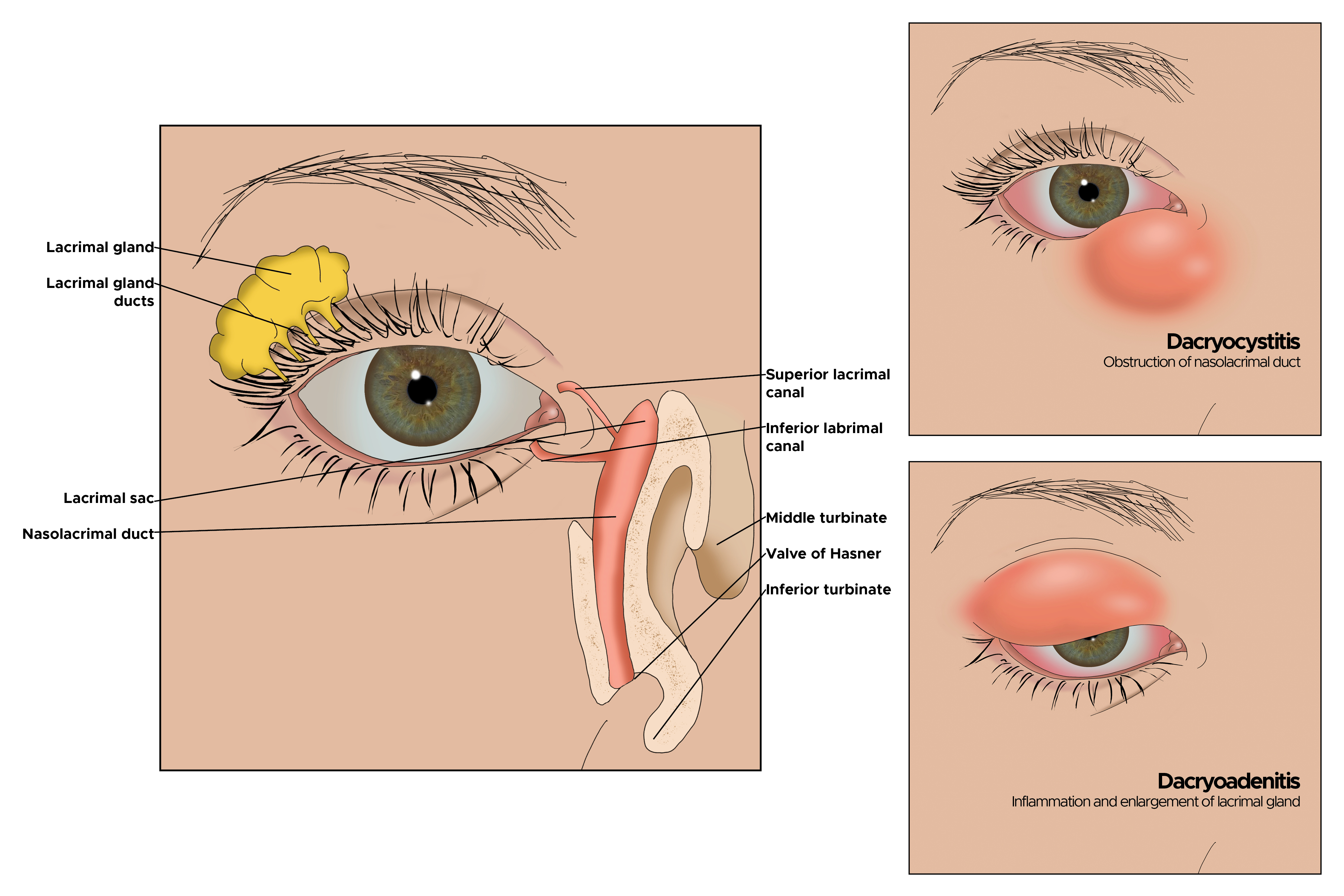 Illustration of eye. Lacrimal gland and ducts, lacrimal sac, nasolacrimal duct. Lacrimal canal (superior, inferior), middle turbinate, valve of Hasner, Inferior turbinate. Dacryocystitis and Dacryoadenitis.