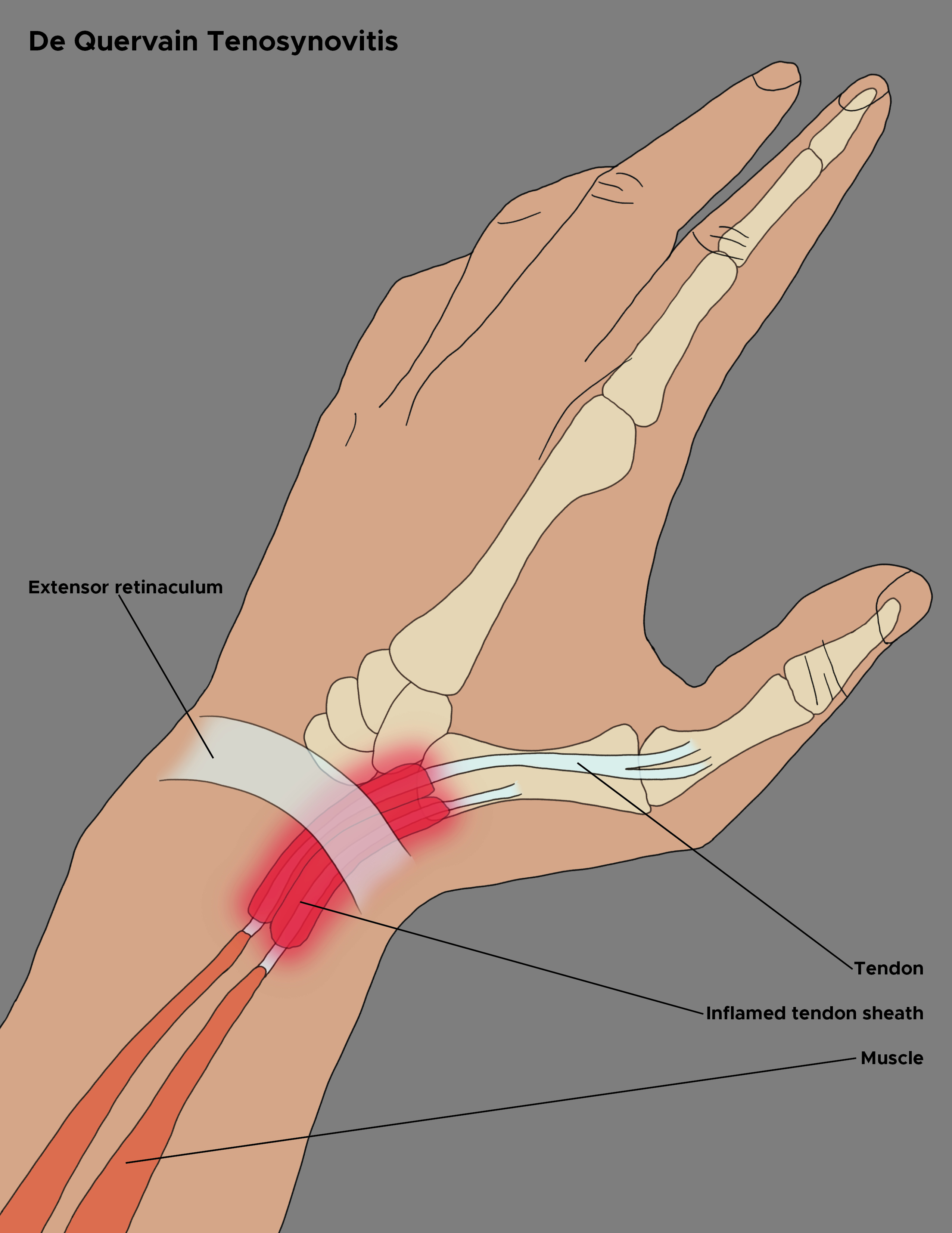 Illustration of De Quervain Tenosynovitis. Extensor retinaculum, wrist tendon, inflamed tendon sheath, muscle.