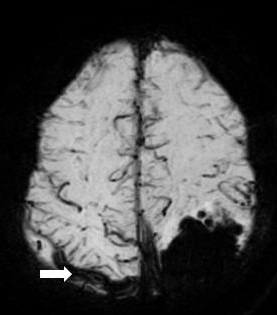 Blooming artifact due to cortical vein thrombosis in susceptibility weighted minimum intensity projection MR sequence