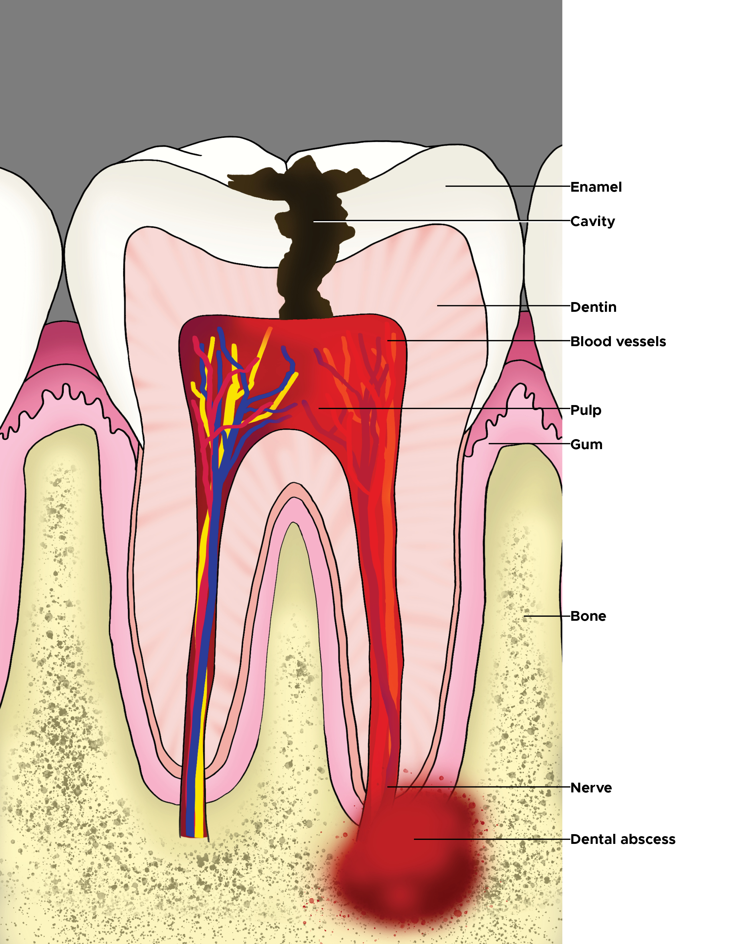 Illustration of molar with cavity and dental abscess. Enamel, cavity, dentin, blood vessels, pulp, gum, bone, nerve