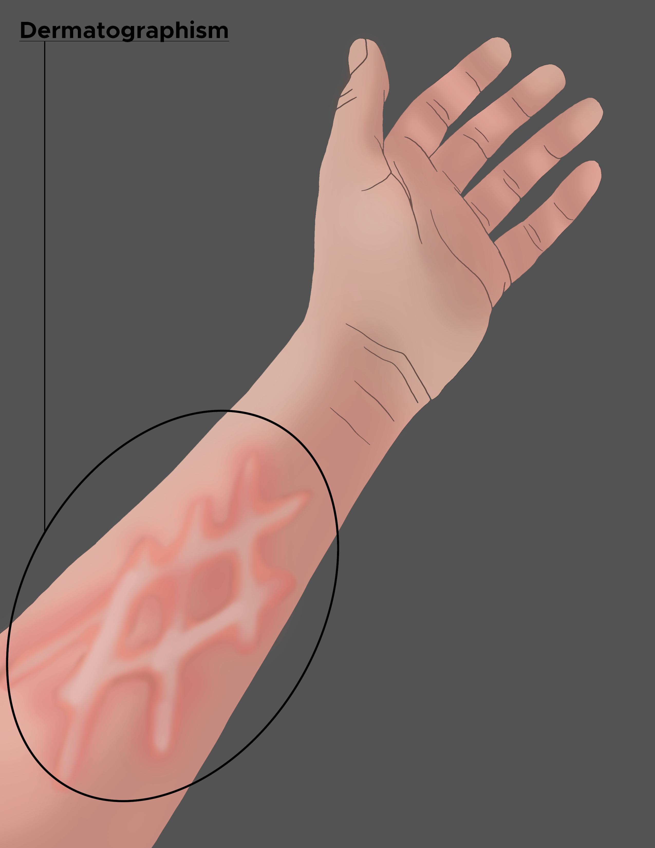 Illustration of forearm displaying dermatographism on skin.