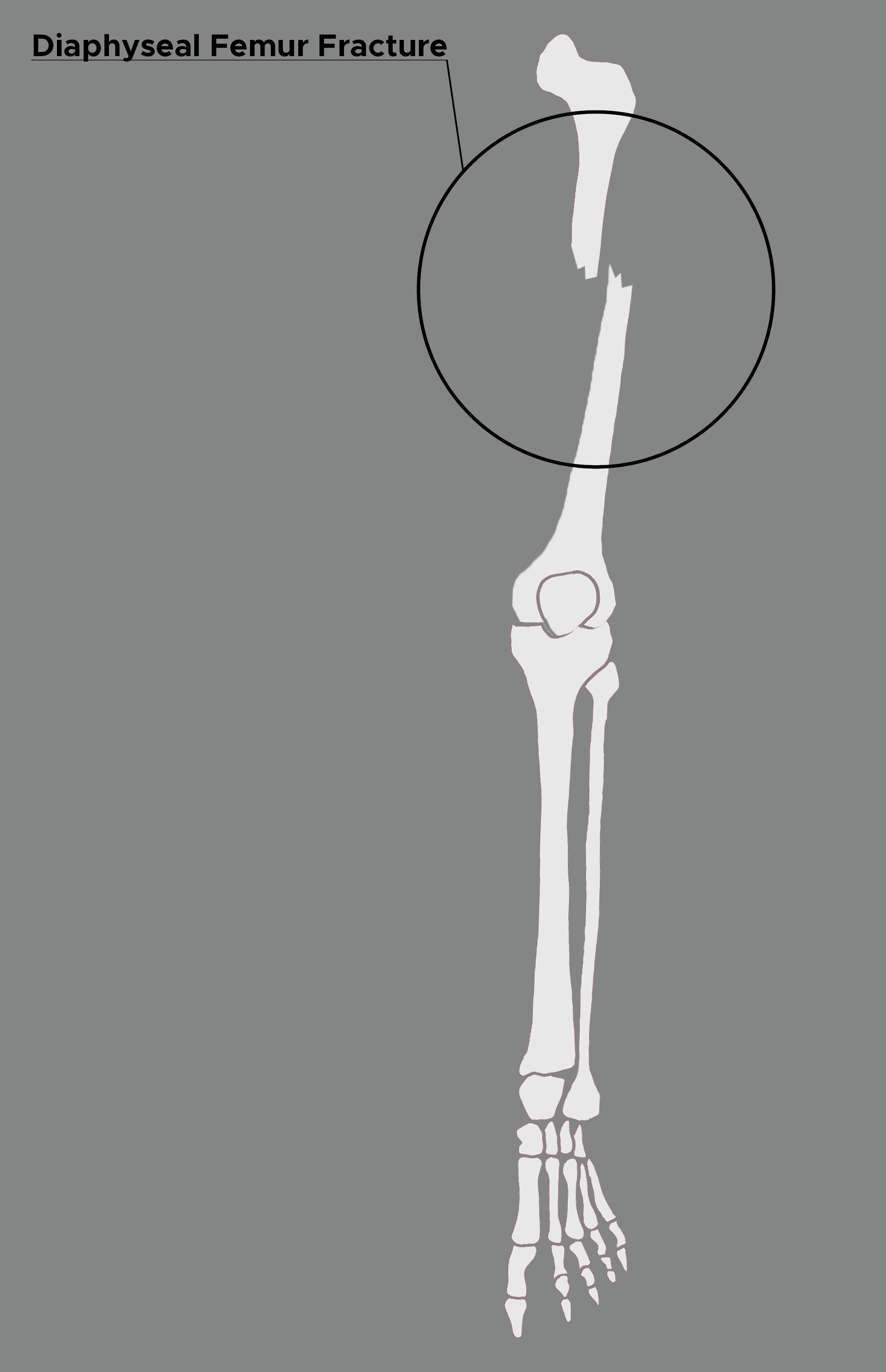 Illustration of femur with Diaphyseal fracture