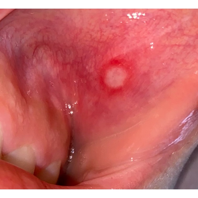 <p>Aphthous Ulcer. This minor ulcer is shown on the labial mucosa.</p>