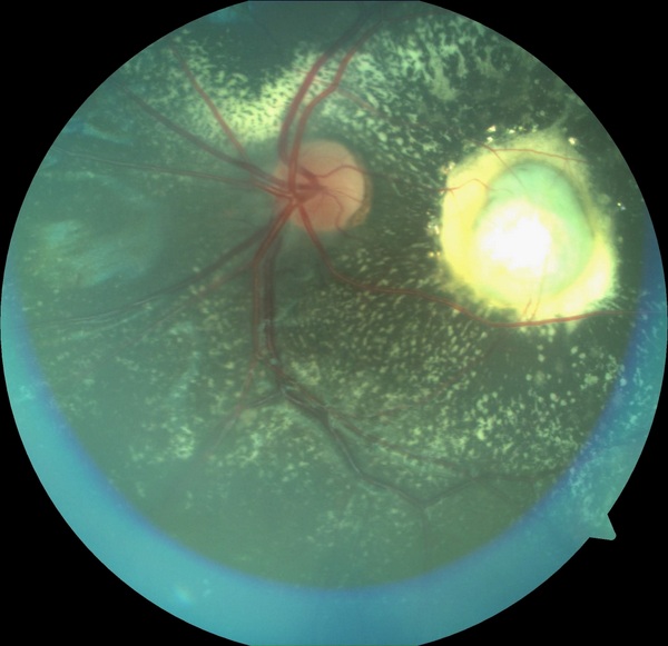 Macular subretinal scar (nodule) and retinal hard exudates in a child with Coats disease
