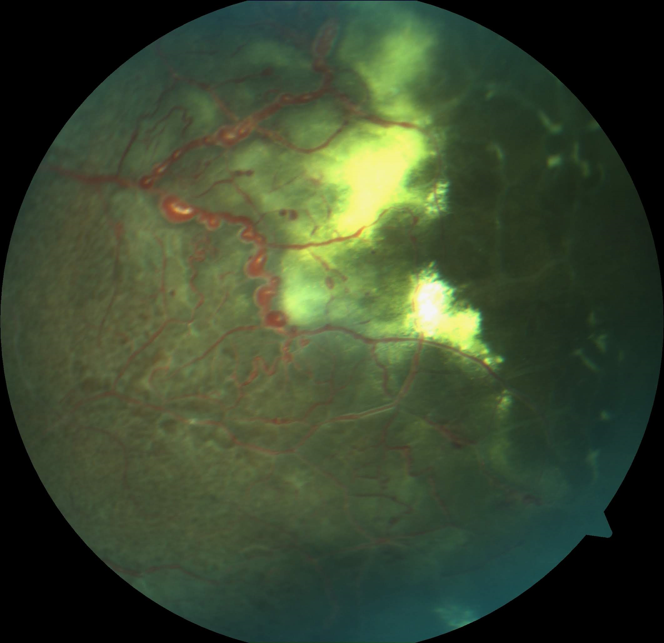 The temporal retina in an eye with Coats disease shows the typical telangiectatic vessels, aneurysms, and hard exudates.