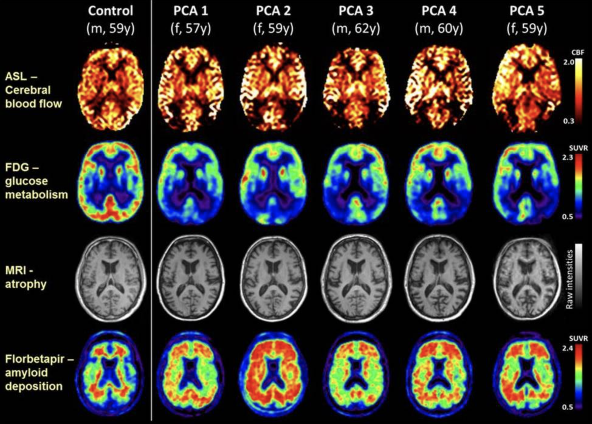 Single-participant axial images for one control participant and five patients with PCA showing cerebral blood flow (ASL), glucose metabolism (FDG-PET), atrophy (structural MRI), and amyloid deposition (florbetapir-PET)