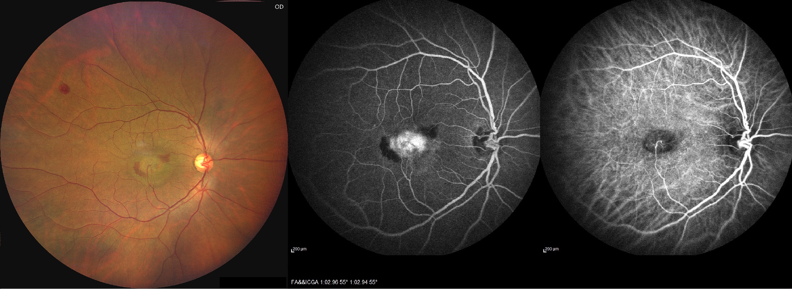 retinal angiomatous proliferation